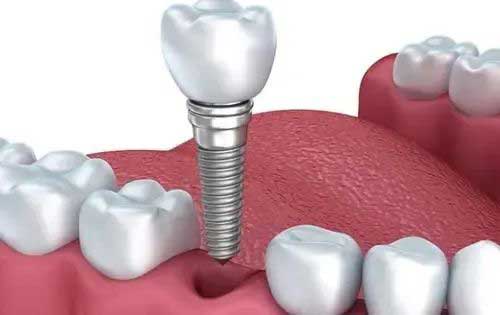 種植牙為何如此受歡迎？這些知識要知曉！